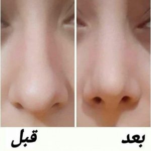 چسب بینی