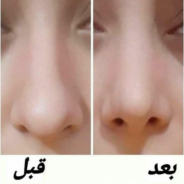 چسب بینی
