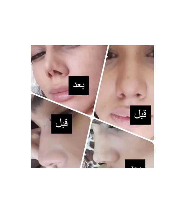 چسب لیفت بینی