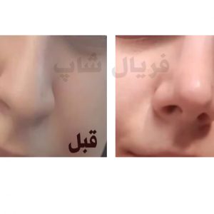 چسب لیفت بینی