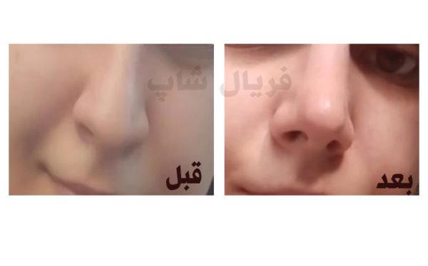 چسب لیفت بینی
