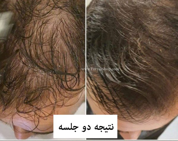 کوکتل رشد مو
